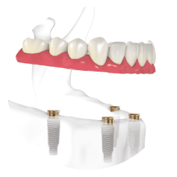 ilustración sobre implante dental